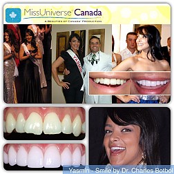 porcelain_veneers_28