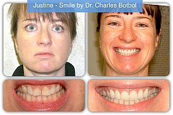 porcelain_veneers_13