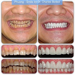 porcelain_veneers_08