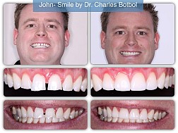porcelain_veneers_04