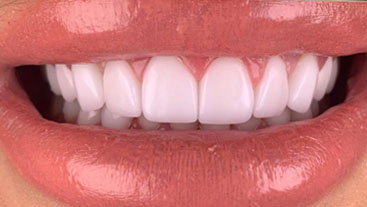Teeth-in-One-Day