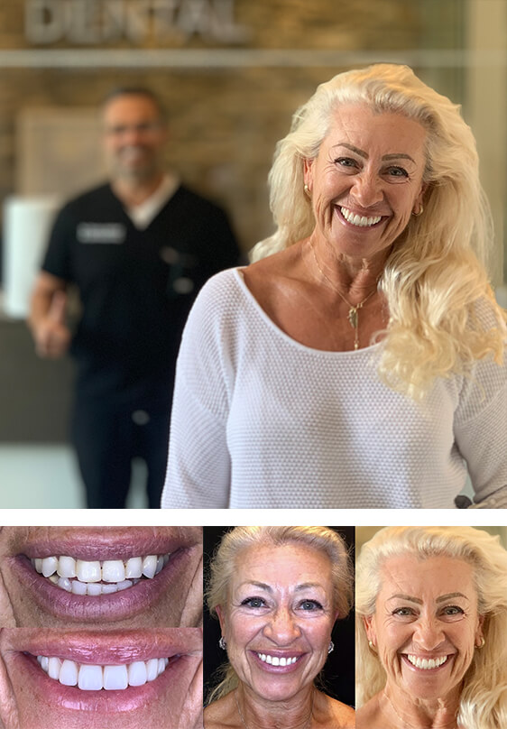 Success Story Teeth-in-1-Day