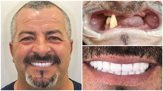 Success Story Teeth-in-1-Day