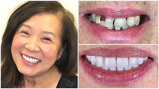 Success Story Teeth-in-1-Day