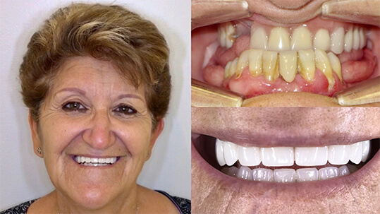 Success Story Teeth-in-1-Day