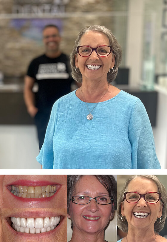 Success Story Teeth-in-1-Day