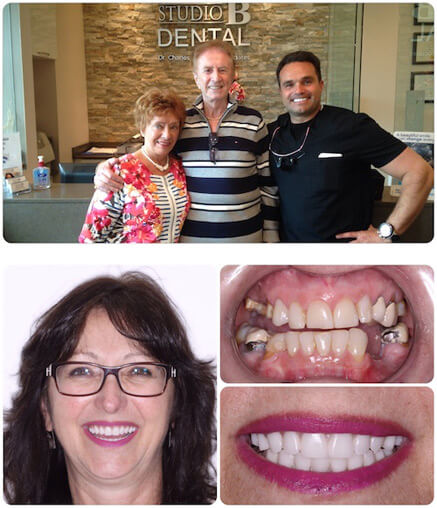 Dental Implants