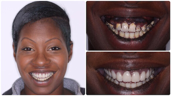 Dental Implants are Often Your Best Choice for a Lost or Missing Tooth