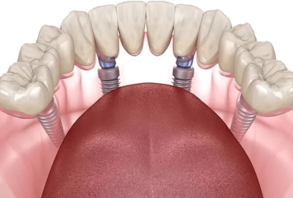 Simplify Tooth Replacement with Teeth-in-1-Day Dental Implants