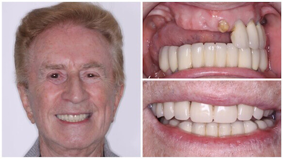 Dental Implants are Often Your Best Choice for a Lost or Missing Tooth