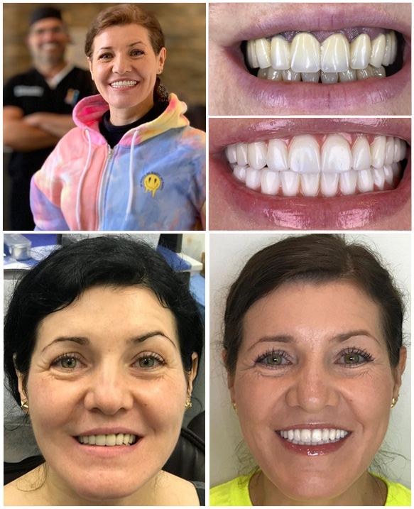 Simplify Tooth Replacement with Teeth-in-1-Day Dental Implants