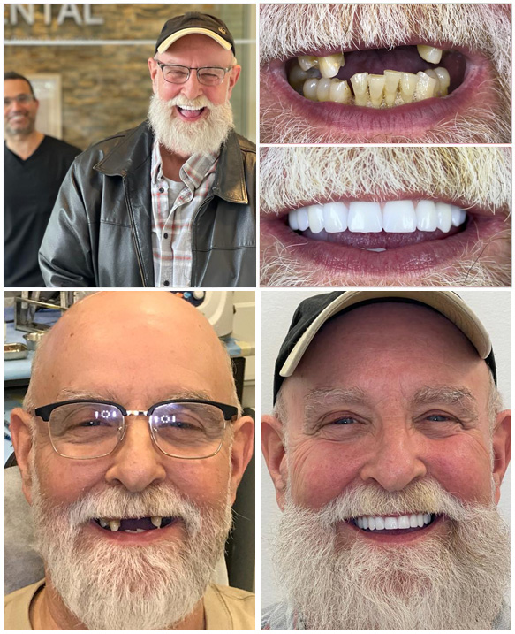 Simplify Tooth Replacement with Teeth-in-1-Day Dental Implants
